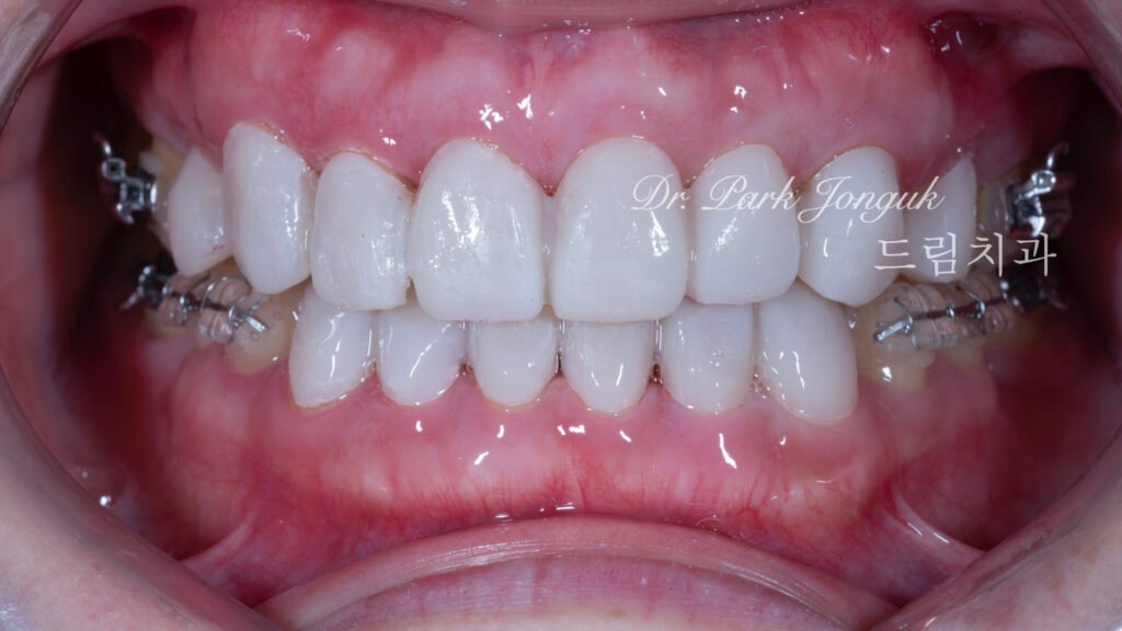 테트라사이클린 변색 라미네이트