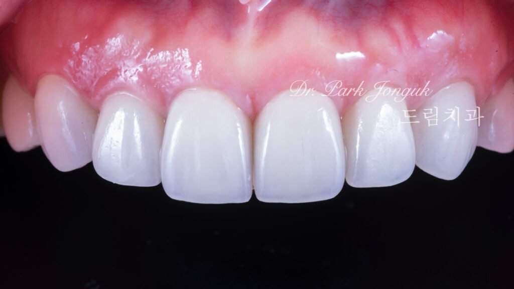 테트라사이클린 변색 라미네이트