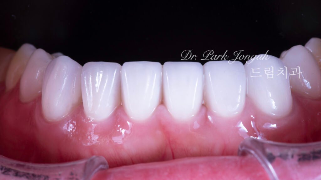 테트라사이클린 변색 라미네이트