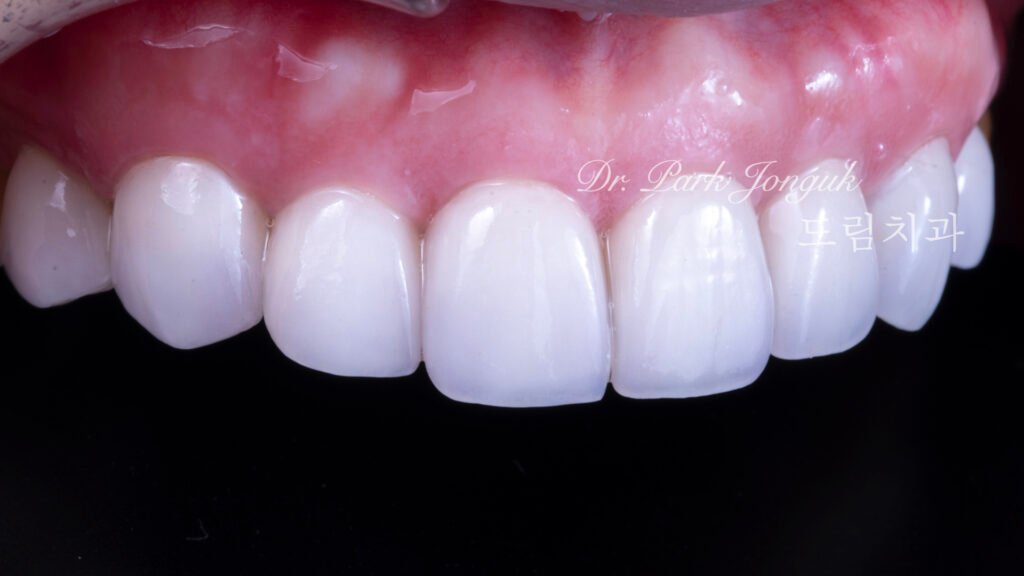 테트라사이클린 변색 라미네이트