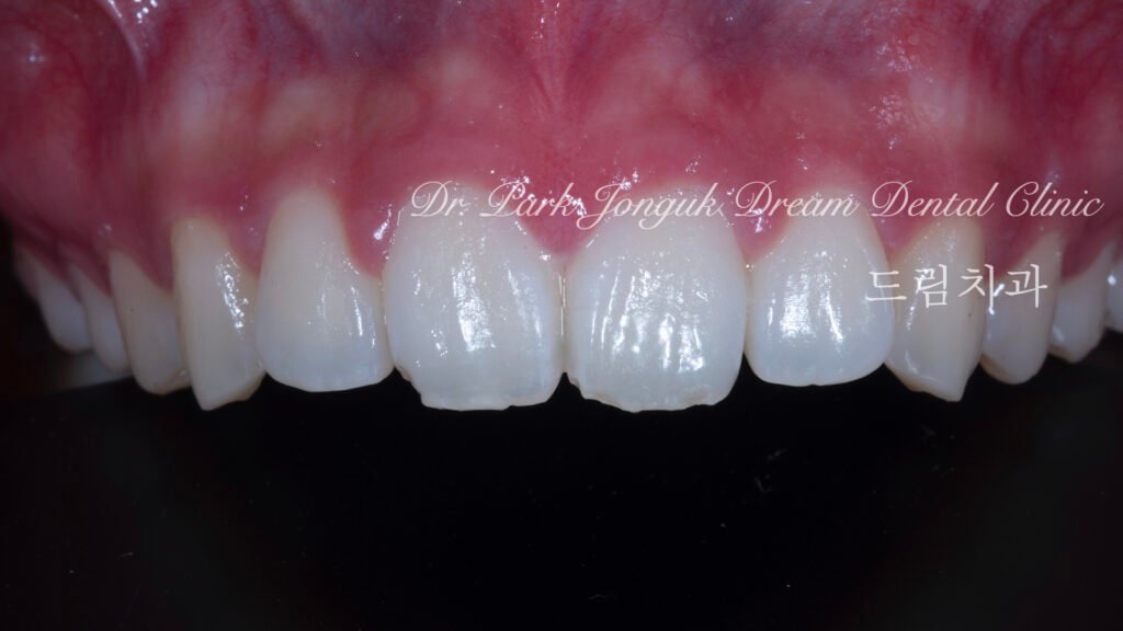 깨진치아 앞니 라미네이트