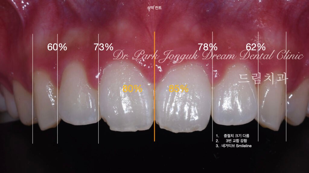 깨진치아 앞니 라미네이트
