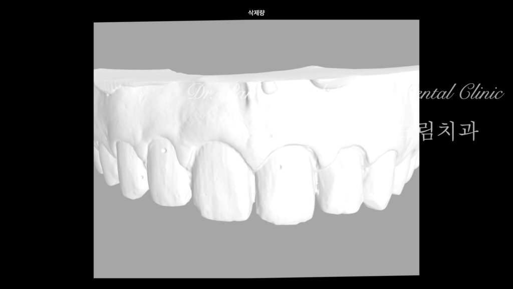 깨진치아 앞니 라미네이트