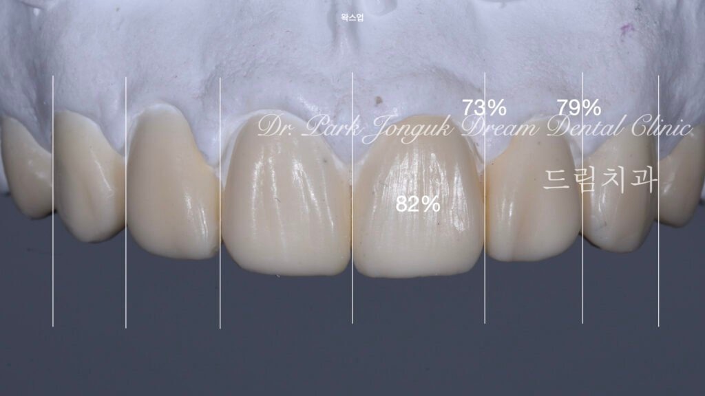 깨진치아 앞니 라미네이트