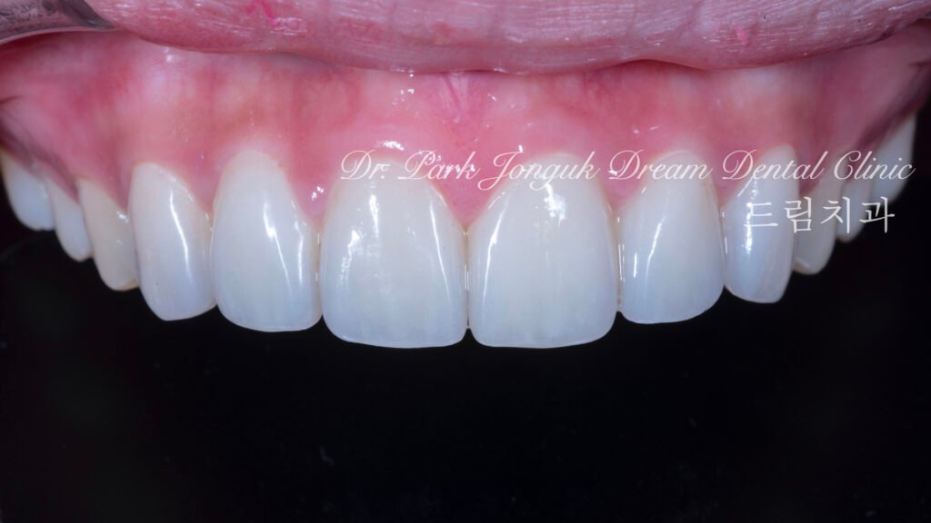 깨진치아 앞니 라미네이트