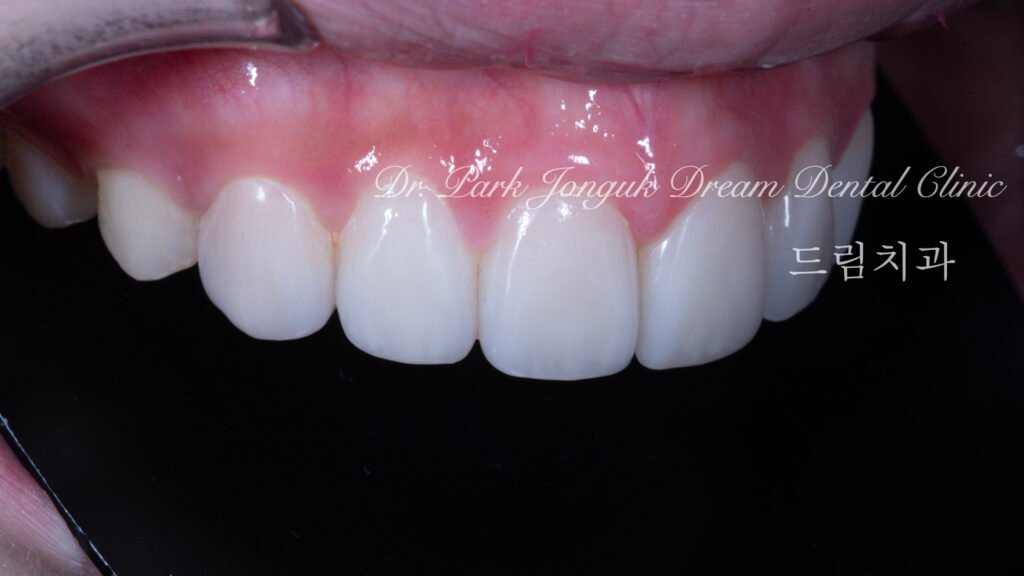깨진치아 앞니 라미네이트