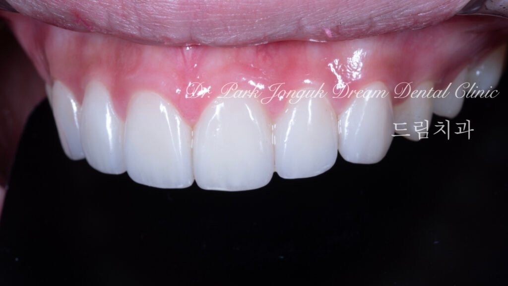 깨진치아 앞니 라미네이트
