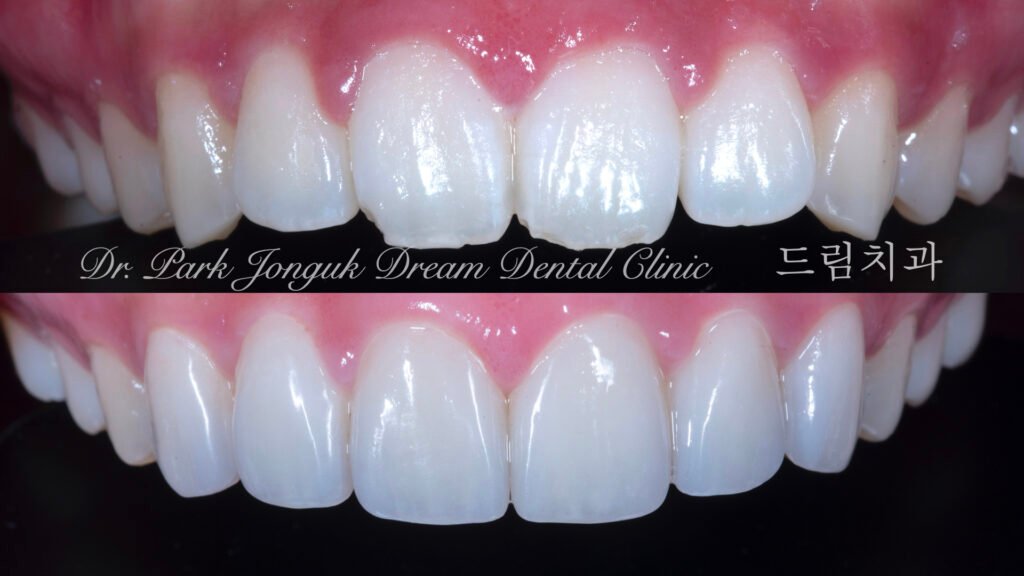 깨진치아 앞니 라미네이트
