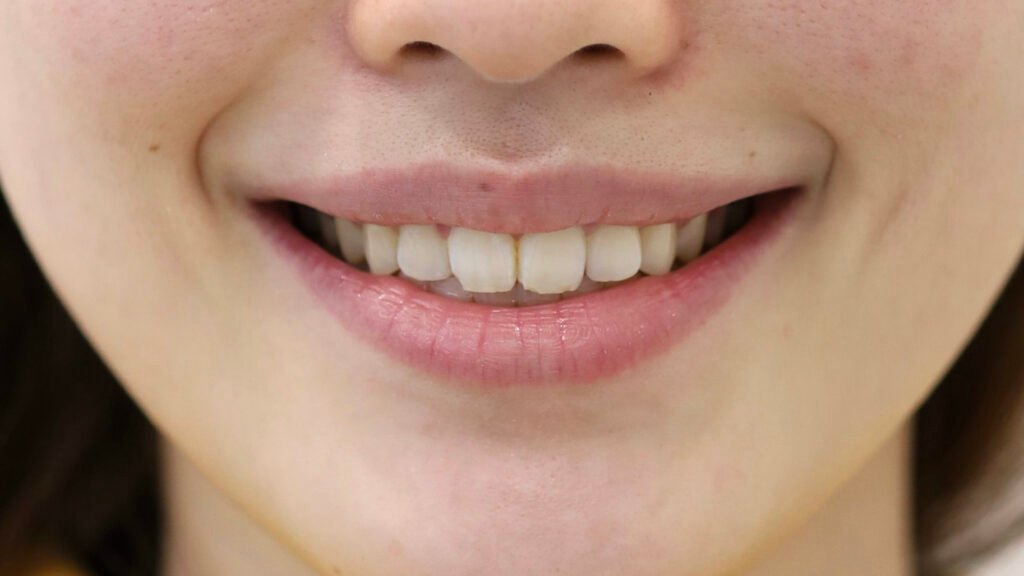 깨진치아 앞니 라미네이트