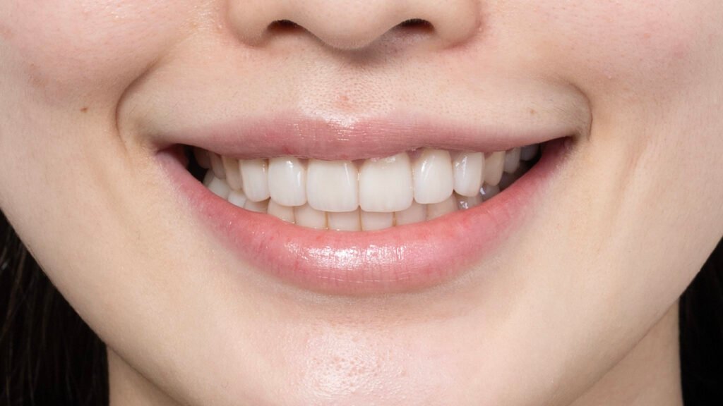 깨진치아 앞니 라미네이트