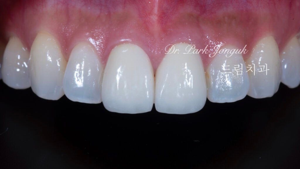 올세라믹 크라운 재시술 무삭제 라미네이트
