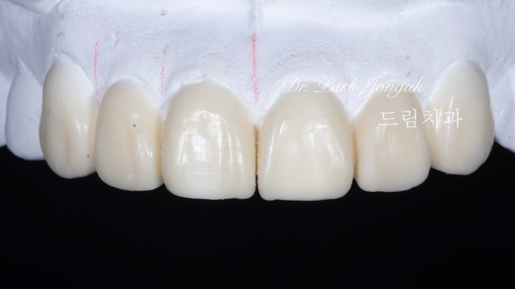 올세라믹 크라운 재시술 무삭제 라미네이트