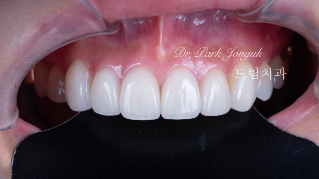 올세라믹 크라운 재시술 무삭제 라미네이트