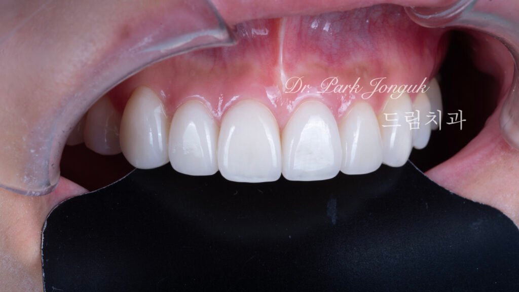 올세라믹 크라운 재시술 무삭제 라미네이트