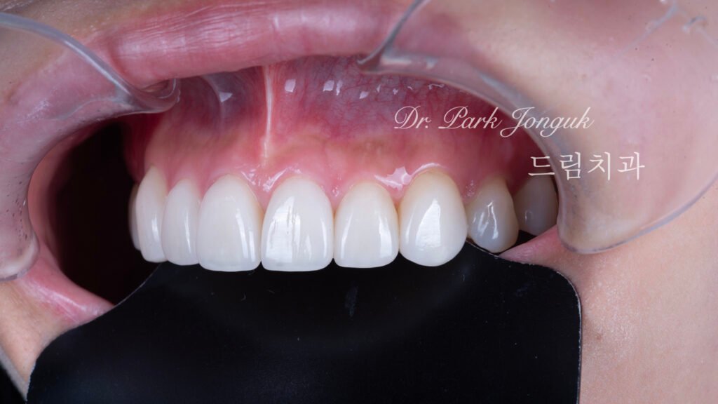 올세라믹 크라운 재시술 무삭제 라미네이트