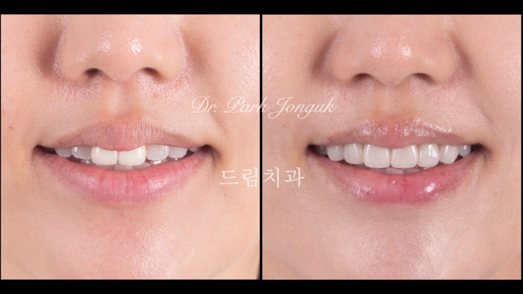 올세라믹 크라운 재시술 무삭제 라미네이트