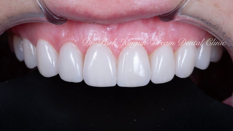 라미네이트 재시술