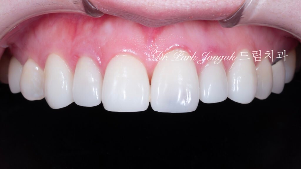 강남 라미네이트 재시술 잘하는 곳