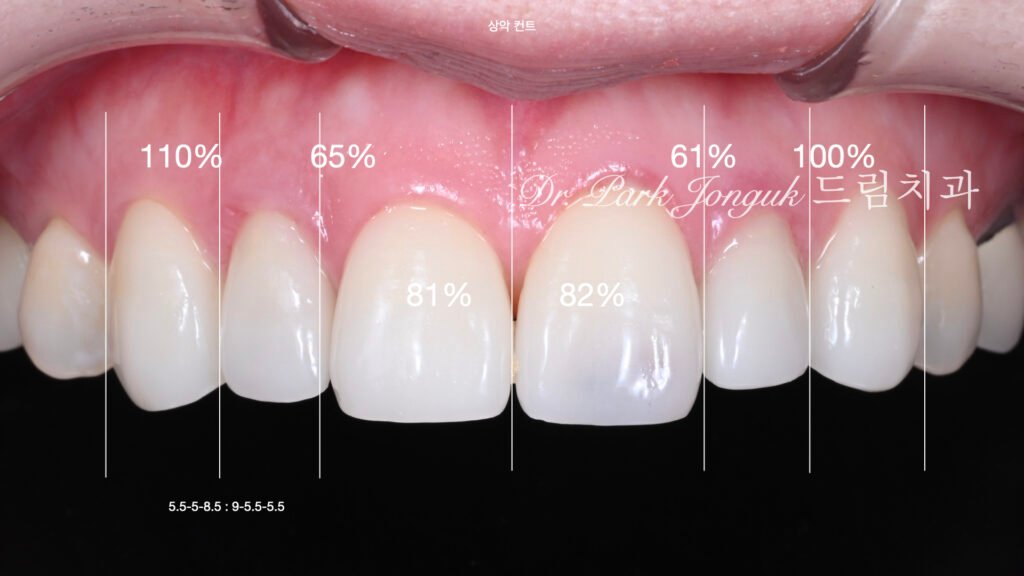 강남 라미네이트 재시술 잘하는 곳