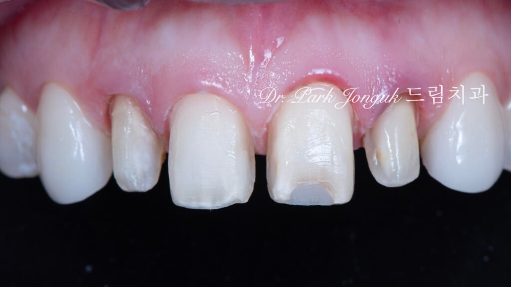 강남 라미네이트 재시술 잘하는 곳