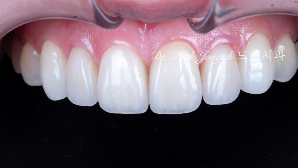 강남 라미네이트 재시술 잘하는 곳