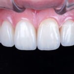 강남 라미네이트 재시술 잘하는 곳