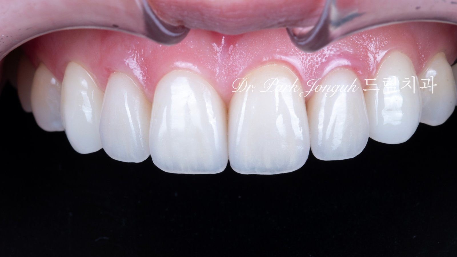 강남 라미네이트 재시술 잘하는 곳