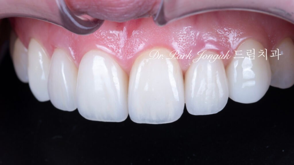 강남 라미네이트 재시술 잘하는 곳