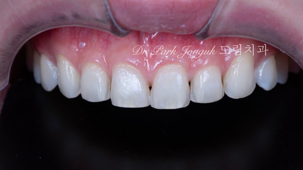 무삭제 라미네이트