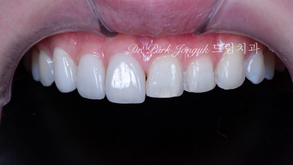 무삭제 라미네이트