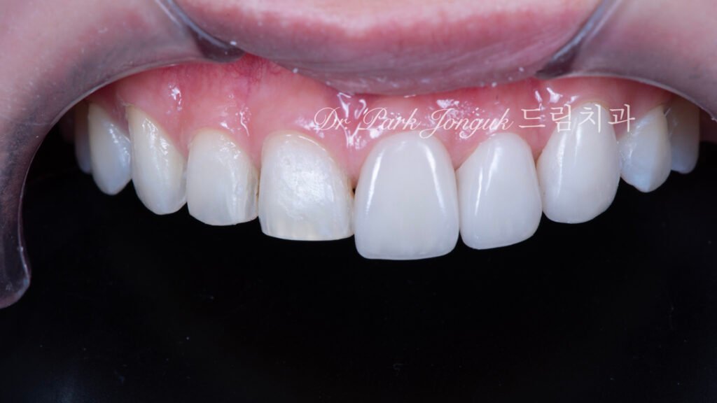 무삭제 라미네이트