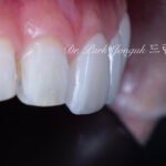 무삭제 라미네이트