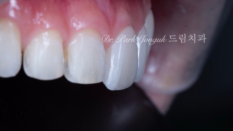 무삭제 라미네이트