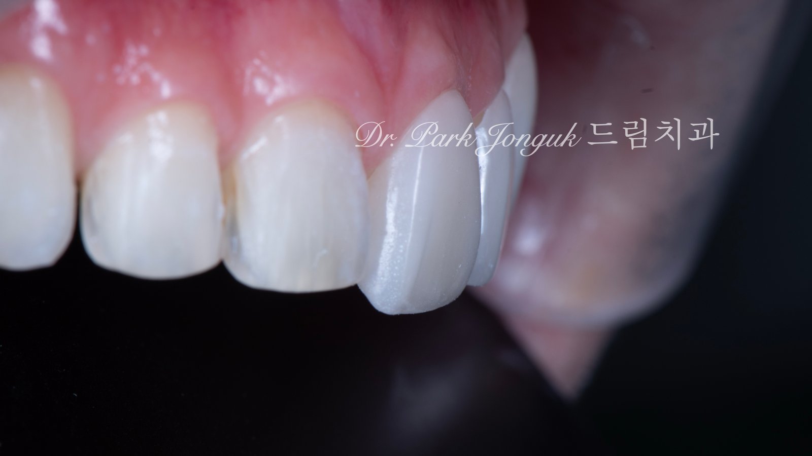 무삭제 라미네이트