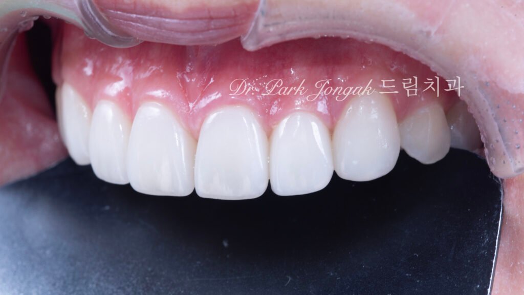 무삭제 라미네이트