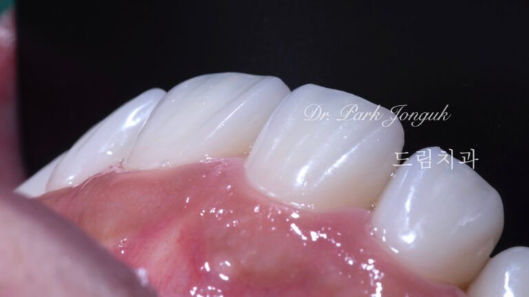 교정후 옥니 무삭제 라미네이트