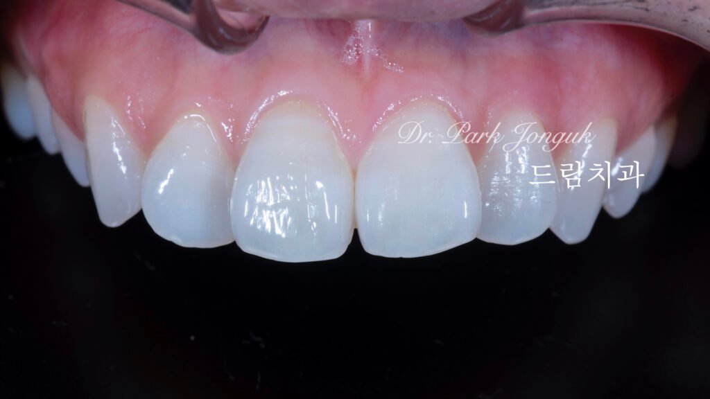 빠드러진 돌출치아 라미네이트