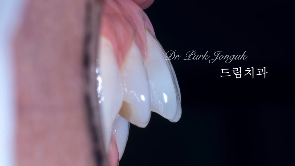 빠드러진 돌출치아 라미네이트
