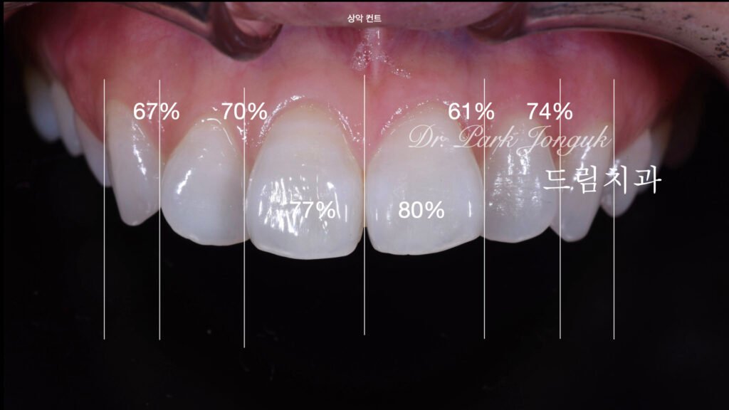 빠드러진 돌출치아 라미네이트