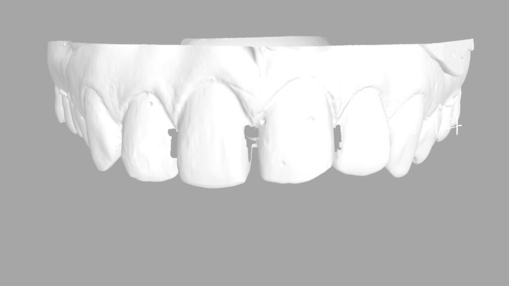 빠드러진 돌출치아 라미네이트