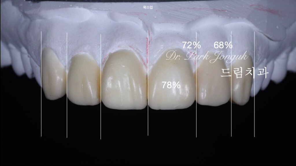 빠드러진 돌출치아 라미네이트