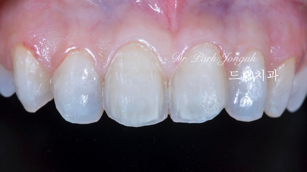 빠드러진 돌출치아 라미네이트