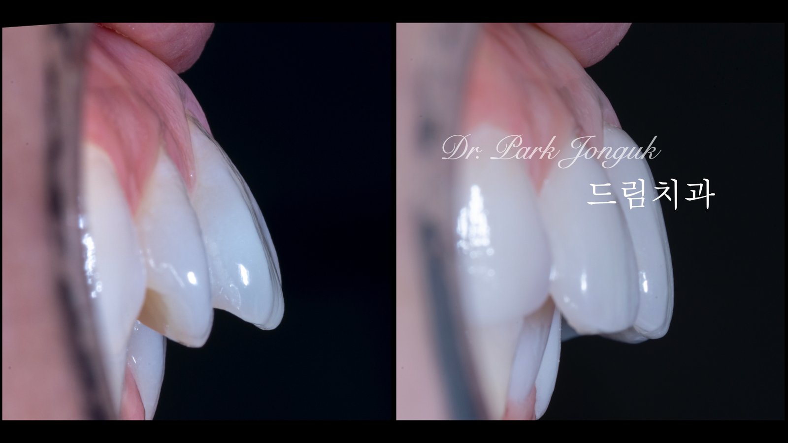 빠드러진 돌출치아 라미네이트