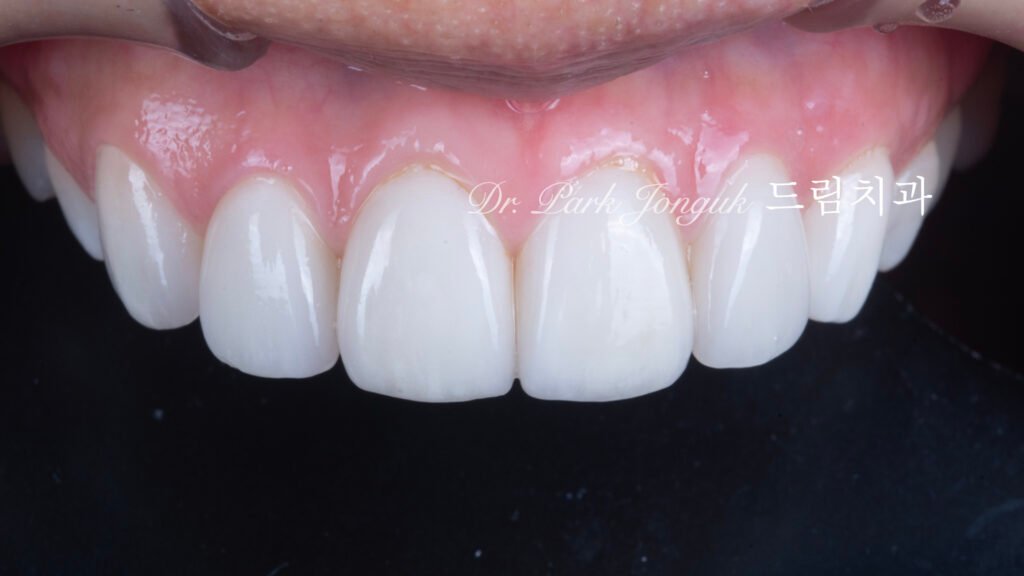빠드러진 돌출치아 라미네이트