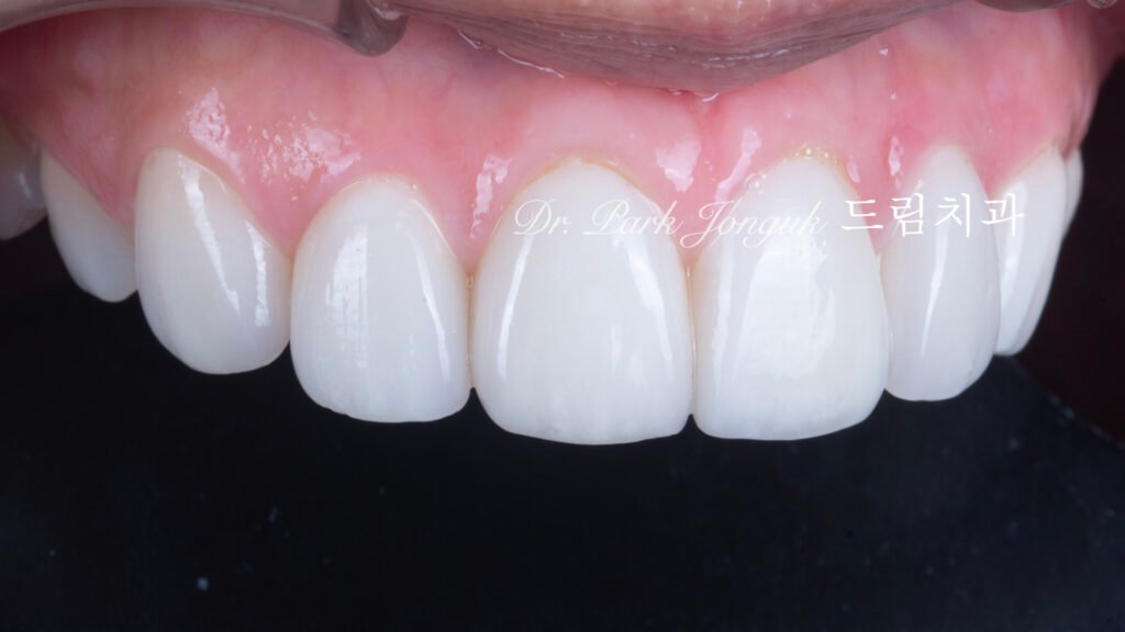 빠드러진 돌출치아 라미네이트