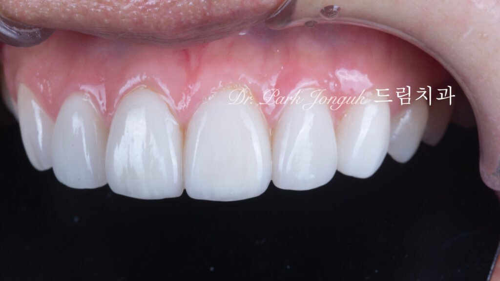 빠드러진 돌출치아 라미네이트