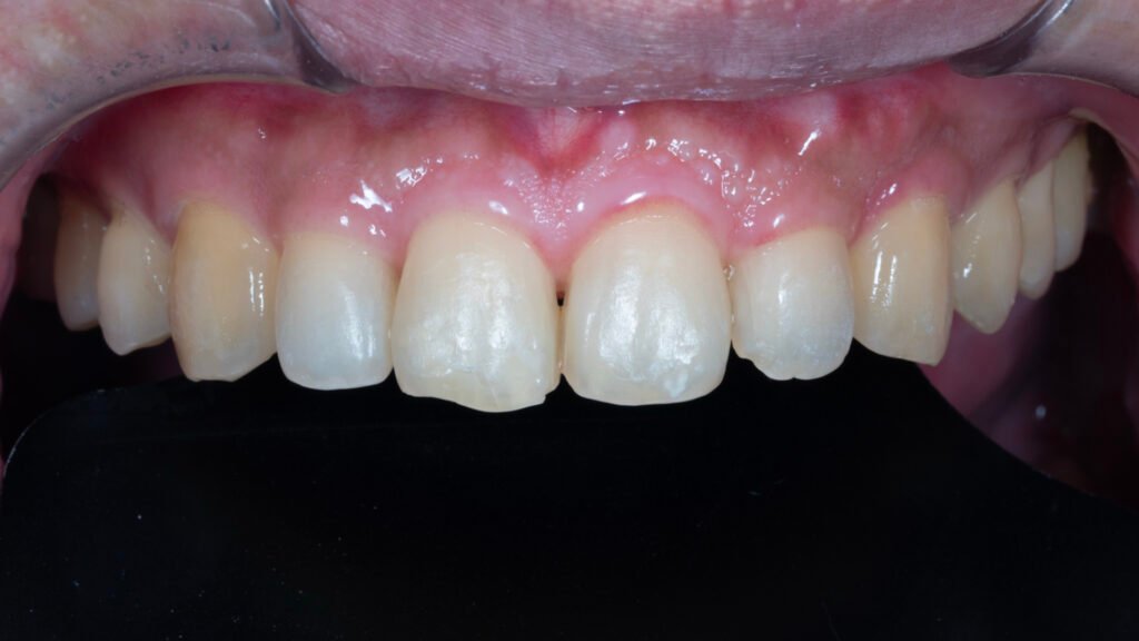 앞니 라미네이트