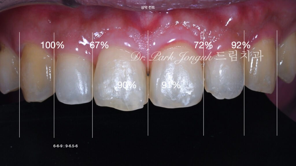 앞니 라미네이트