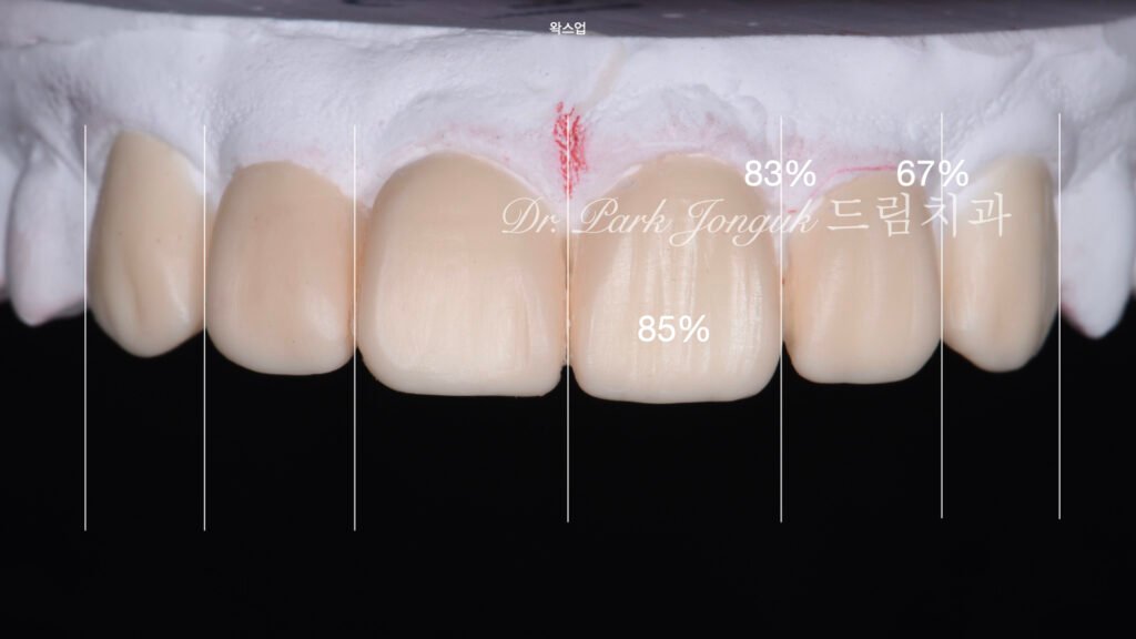 앞니 라미네이트