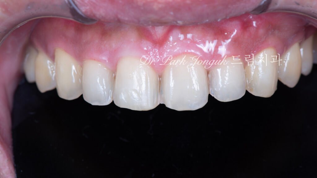 앞니 라미네이트